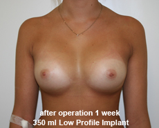 plastic-surgery-breast-augmentation